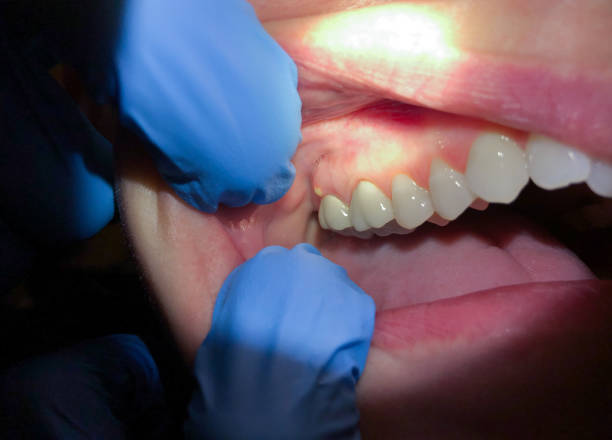 Best Emergency Treatment for Oral Infections in Parlier, CA