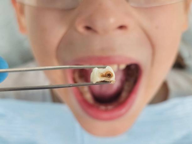 Best Knocked-Out Tooth (Avulsed Tooth) Treatment in Parlier, CA
